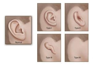 implant a new ear